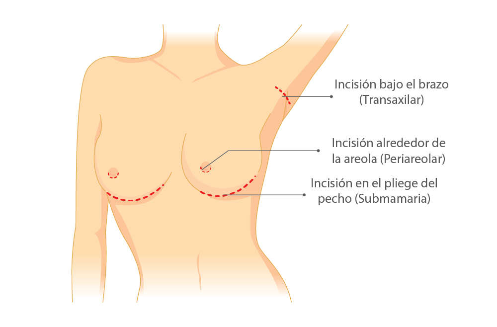 tipos de accesos para intervención mamaria