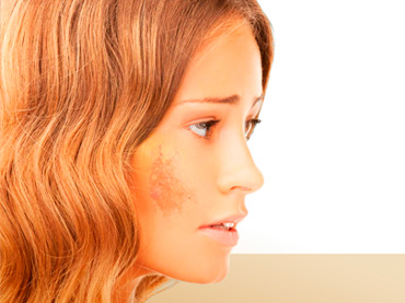 Eliminar manchas en la piel, Dermatología. Pilar de Frutos