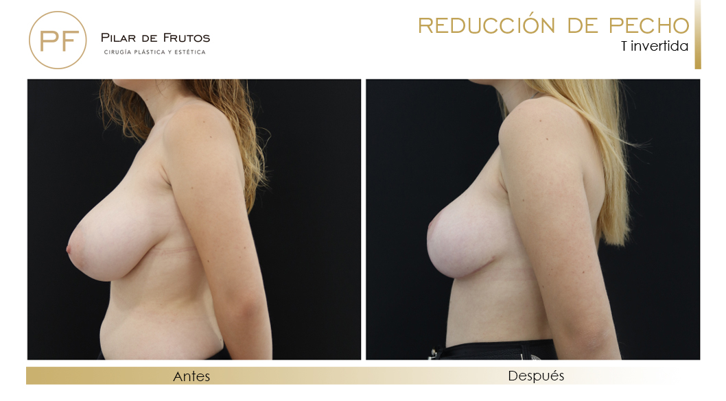 Reducción Pecho: Antes y después. Cirugía mamaria. Pilar de Frutos