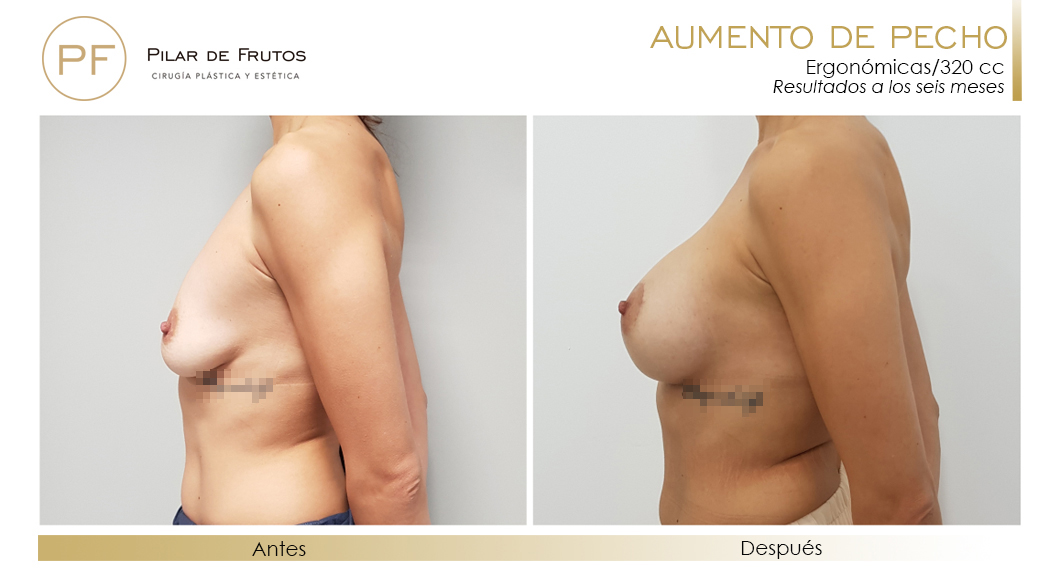 Fotos de aumento de pecho: antes y después. Cirugía mamaria. Pilar de Frutos