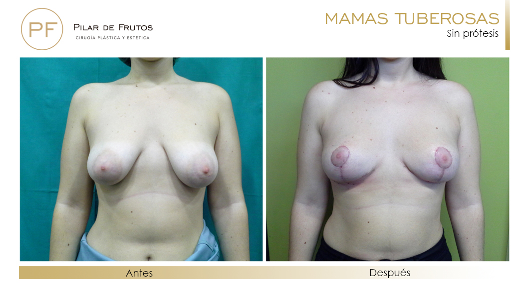 Fotos de mamas tuberosas: antes y después. Cirugía mamaria. Pilar de Frutos
