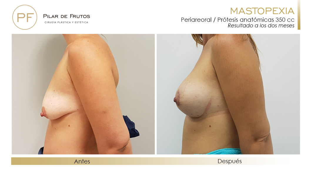 Elevación: antes y después. Cirugía mamaria. Pilar de Frutos
