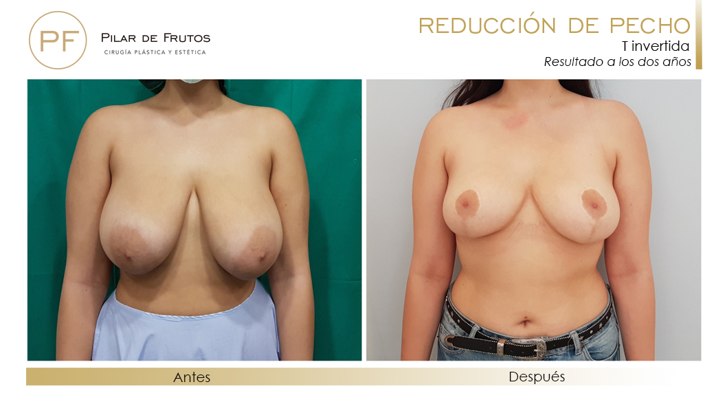 Reducción Pecho: Antes y después. Cirugía mamaria. Pilar de Frutos
