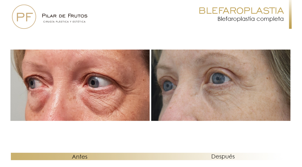 Fotos de Blefaroplastia: antes y después. Pilar de Frutos