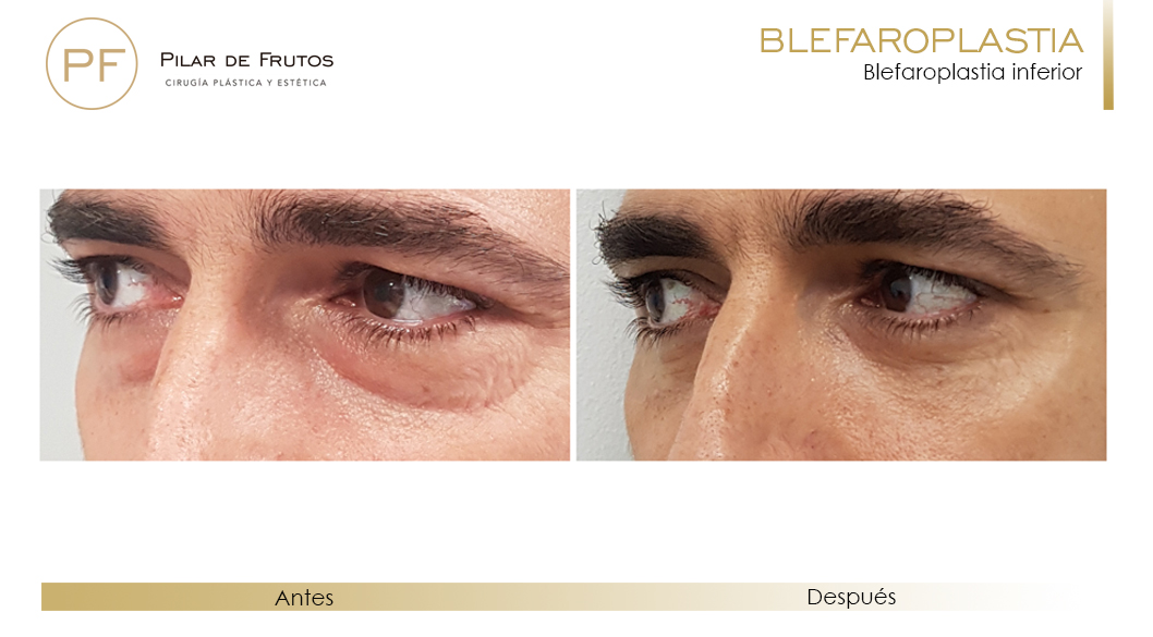 Fotos de Blefaroplastia: antes y después. Pilar de Frutos