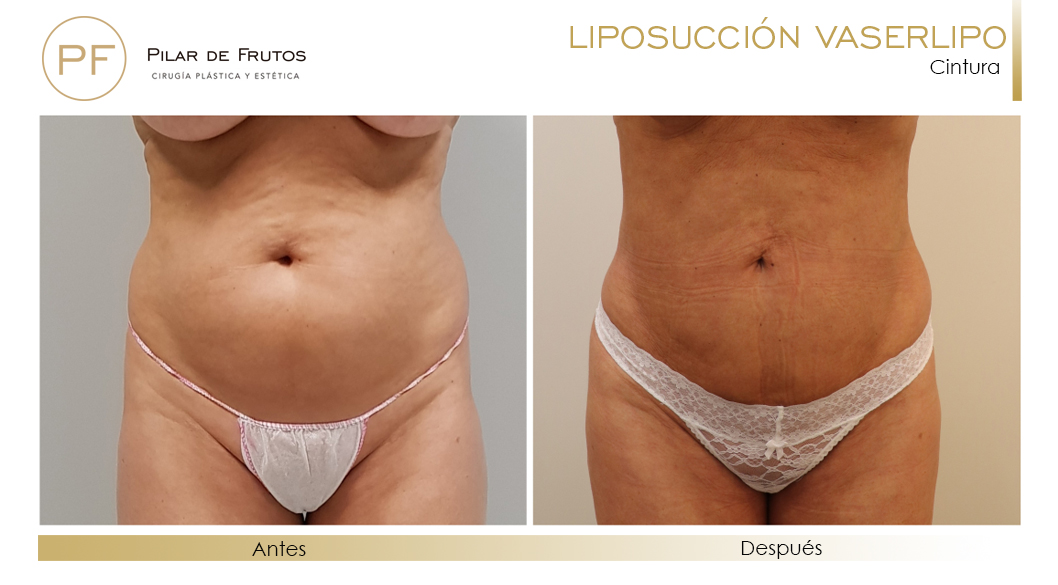 Fotos de Lipoescultura: antes y después