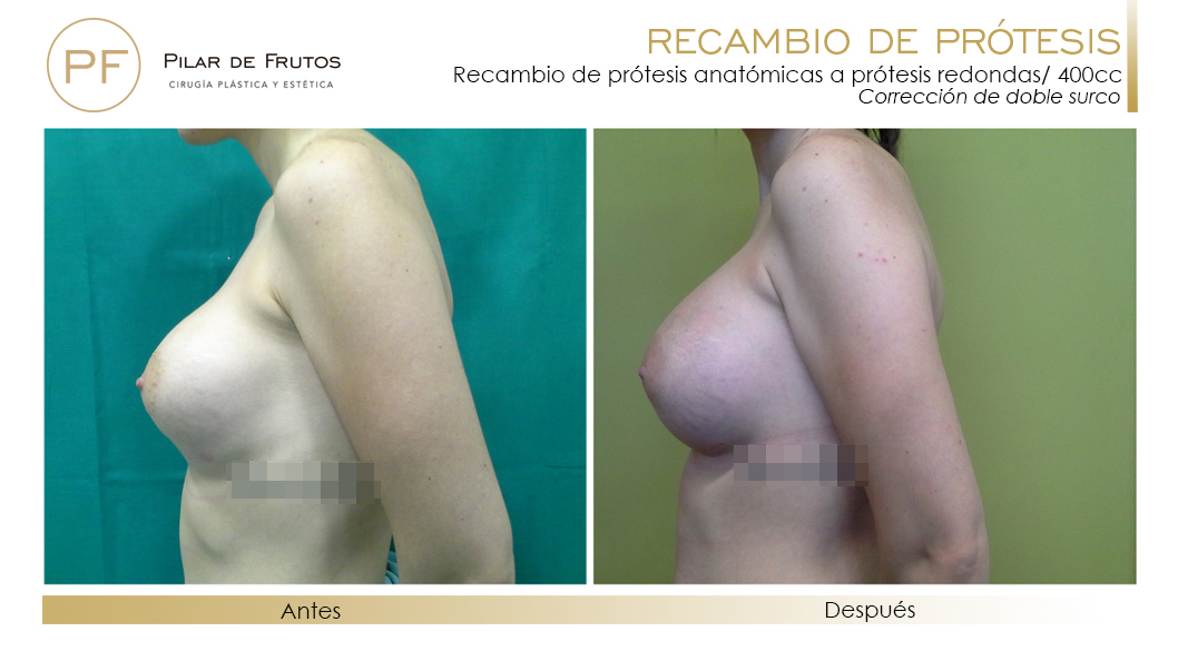 Recambio de prótesis: antes y después