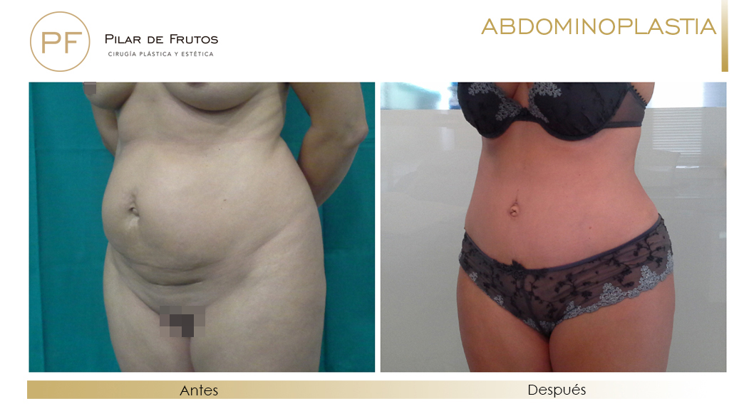 Fotos de Abdominoplastia: antes y despues