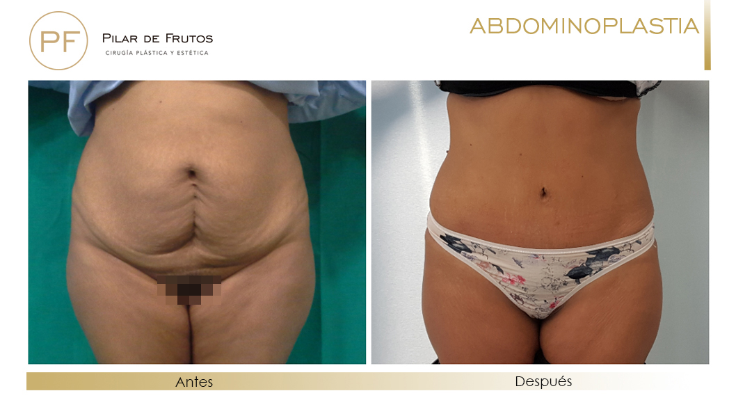 Fotos de Abdominoplastia: antes y despues