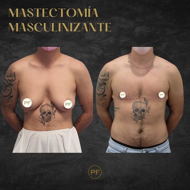 masectomia transexual