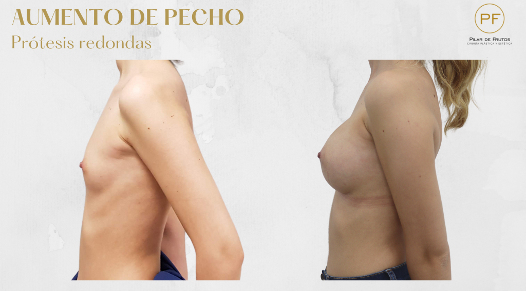 Fotos de aumento de pecho: antes y después. Cirugía mamaria. Pilar de Frutos