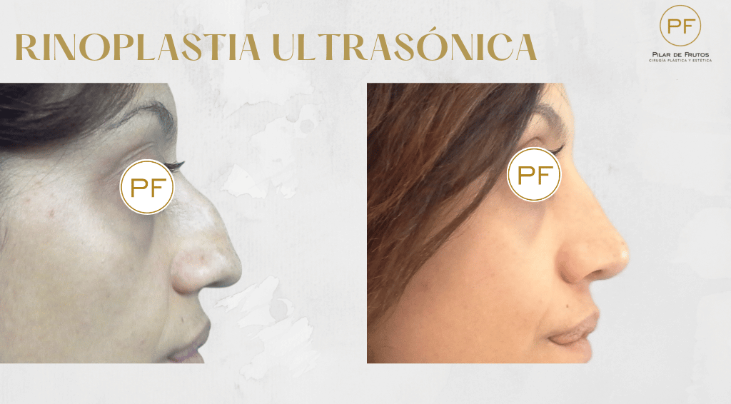 Fotos de Rinoplastia: antes y después. Pilar de Frutos