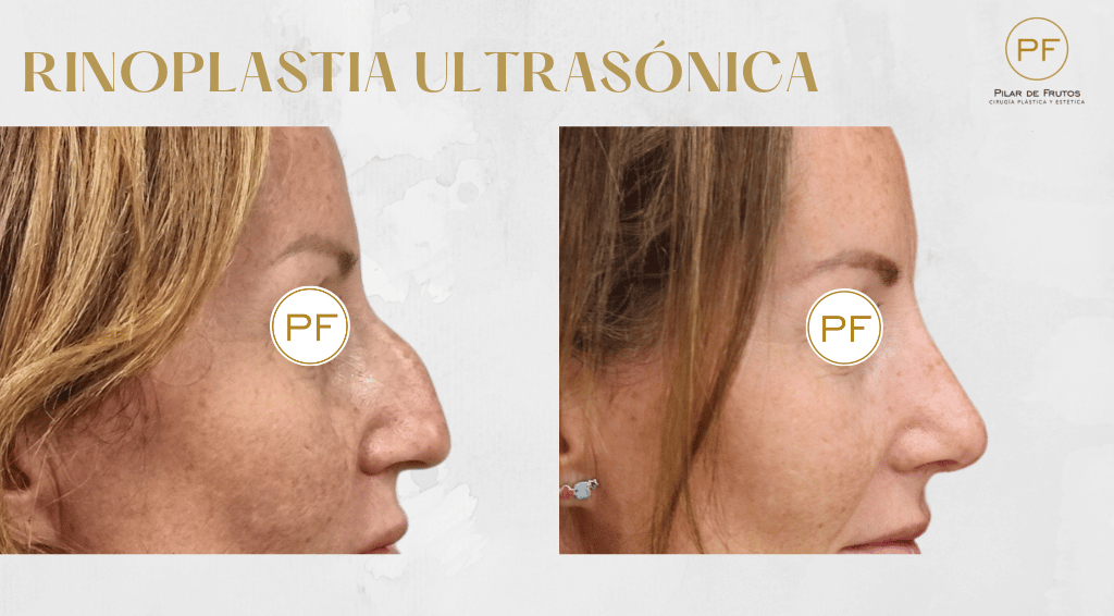 Fotos de Rinoplastia: antes y después. Pilar de Frutos